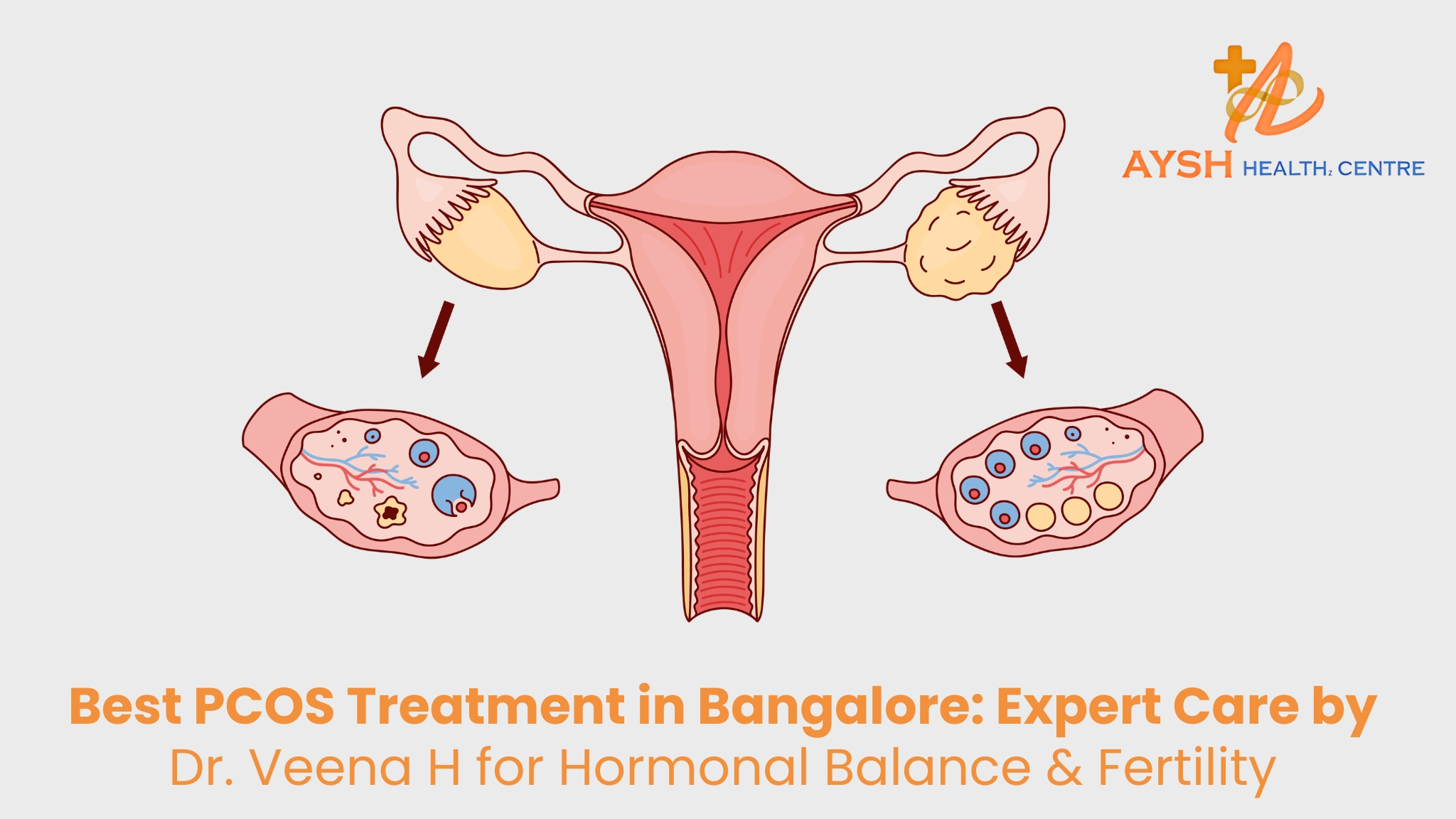 Best PCOS Treatment in Bangalore: Expert Care by Dr. Veena H at Aysh Health Care